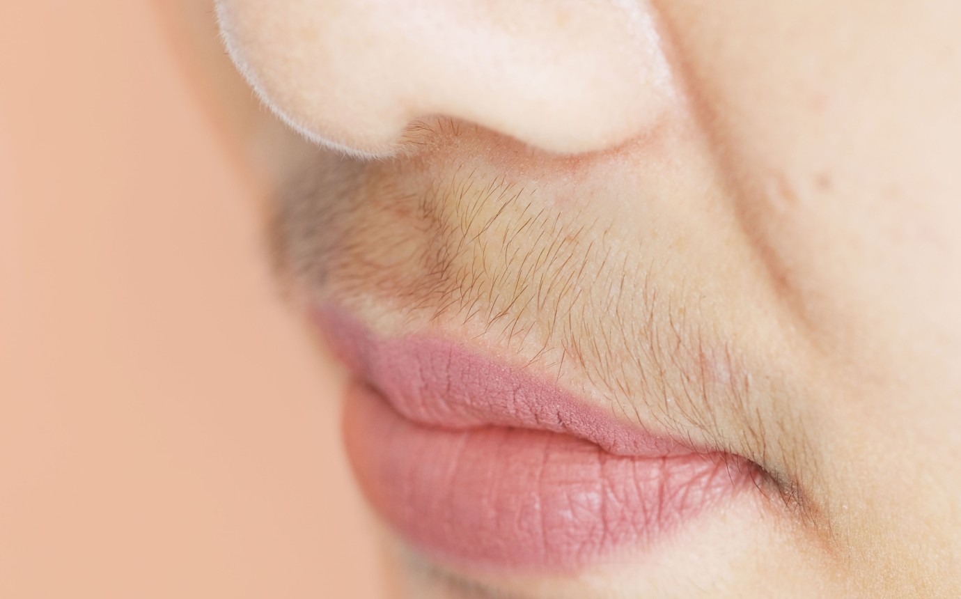 Hirsutismus Hirsutism Guide: